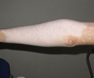 手臂白癜风的症状有哪些呢
